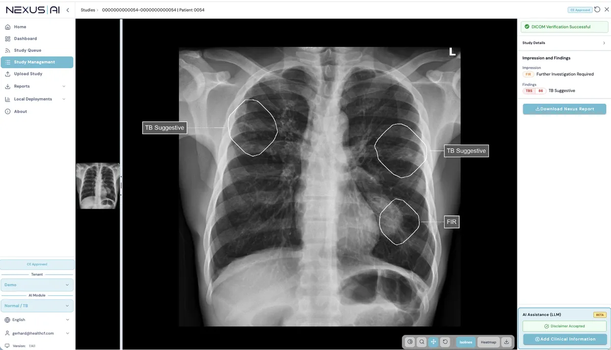 Nyílt AI-modellekkel gyorsítaná a tuberkulózis szűrését a Google