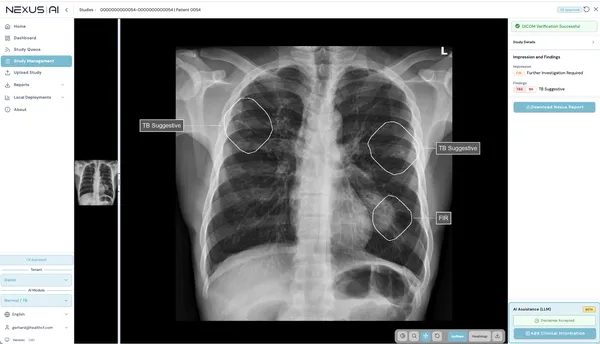 Nyílt AI-modellekkel gyorsítaná a tuberkulózis szűrését a Google